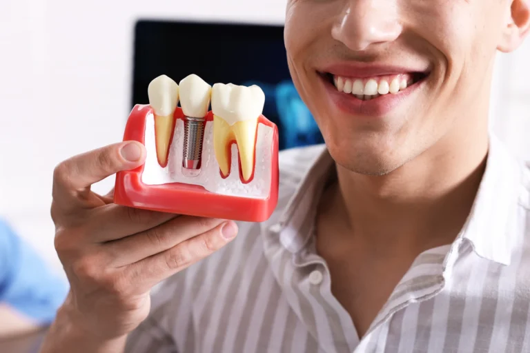impianto dentale e dente naturale